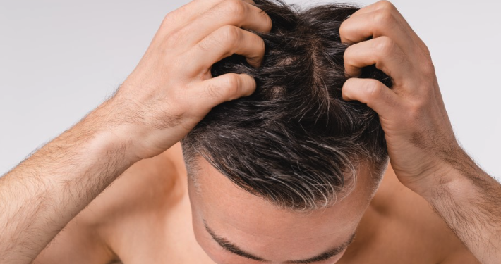 초기 탈모에 대한 핀페시아 의 이점 탐구